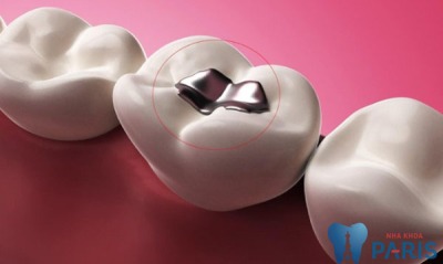 Tìm hiểu chi tiết về trám răng sealant phòng ngừa sâu răng HIỆU QUẢ